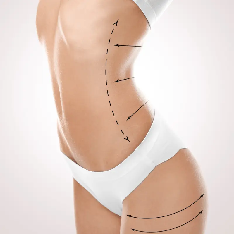 Sculpsure Jimbrantnermd -min