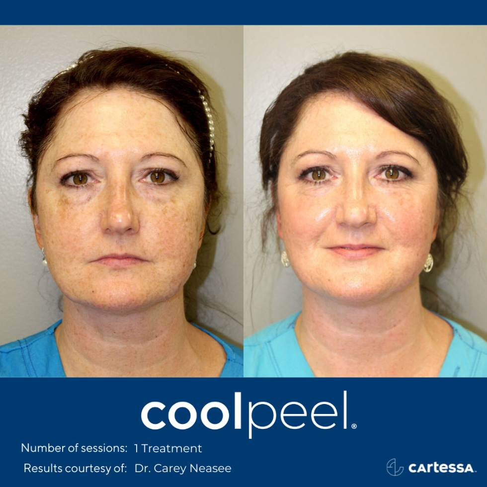 TETRA CO2 COOLPEEL LASER TREATMENT - Jim Brantner MD