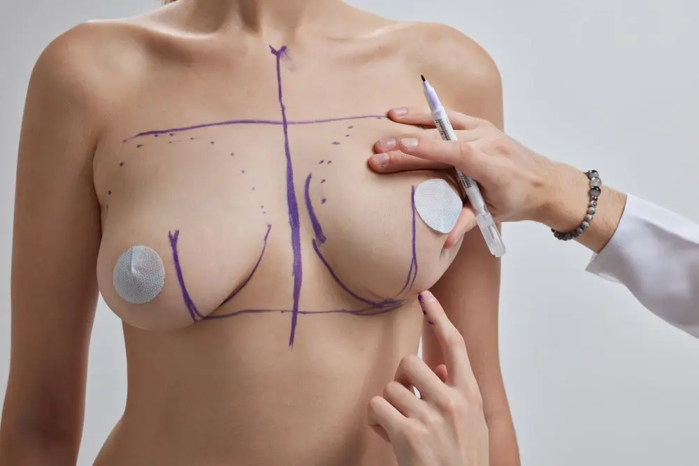 Breast Reduction Surgery
