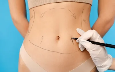 Will I Have Liposuction Scars On My Stomach?