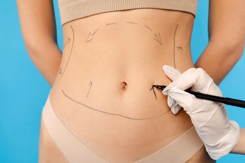 Liposuction Scars