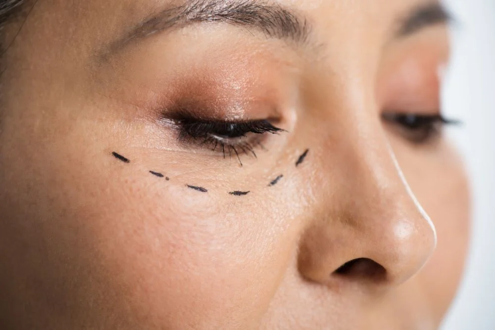 Eyelid Surgery