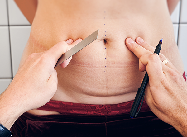Choosing the Right Tummy Tuck Surgeon
