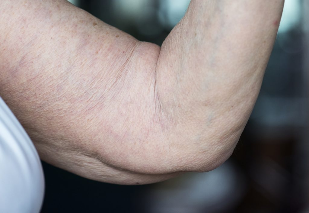 Excess Skin