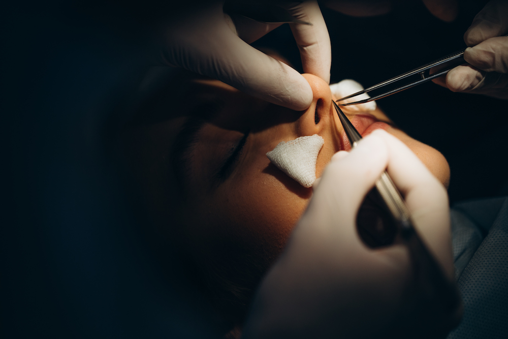 Rhinoplasty