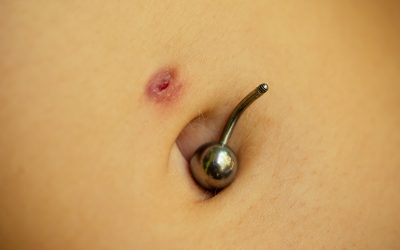 How to Get Rid of a Belly Button Ring Scar?