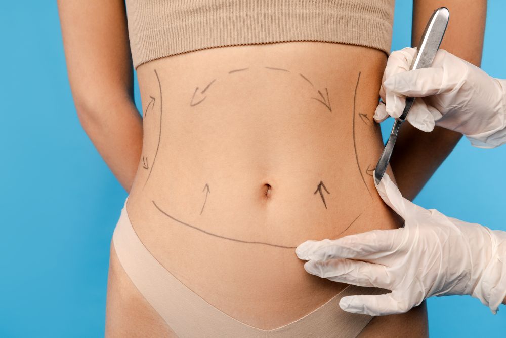Reverse Abdominoplasty for Upper Abdominal Skin