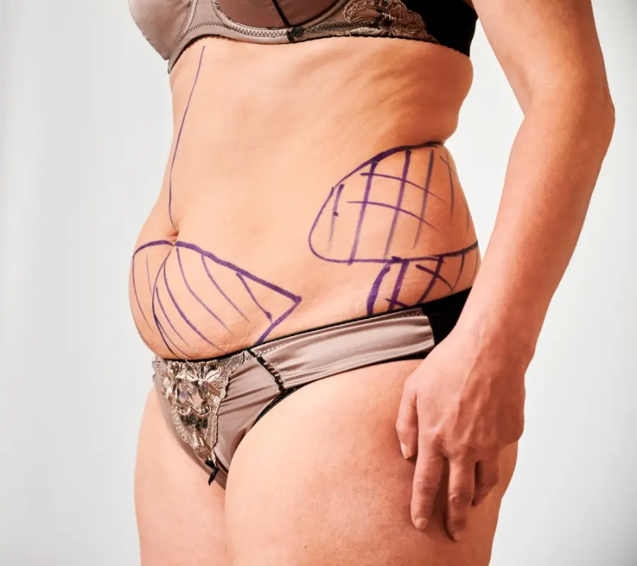 What to Expect 3 Months After Liposuction
