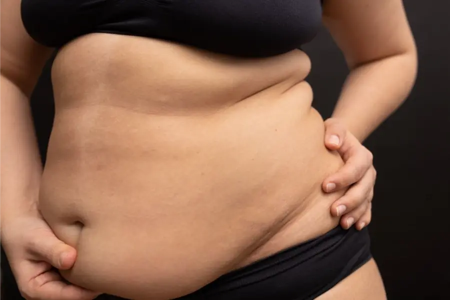 What is the Recovery Time for Full Body Liposuction