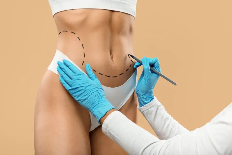 How Long Does It Take to Look Normal After Liposuction