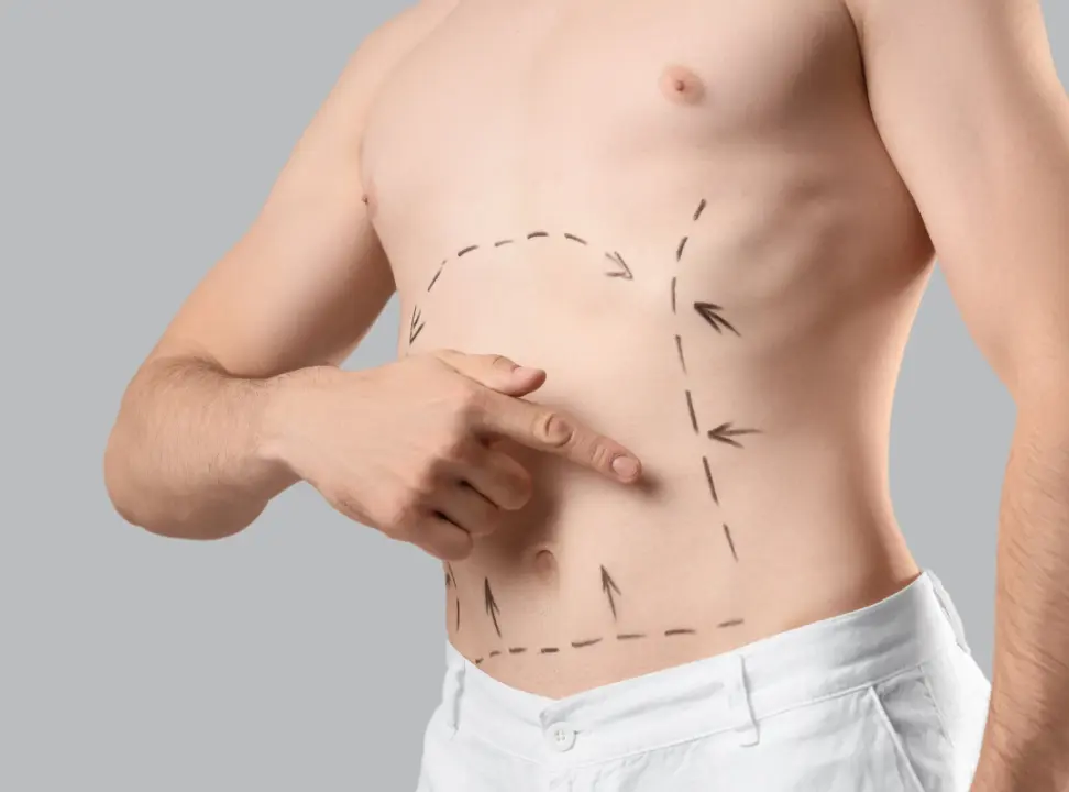 What is the Process of Liposuction