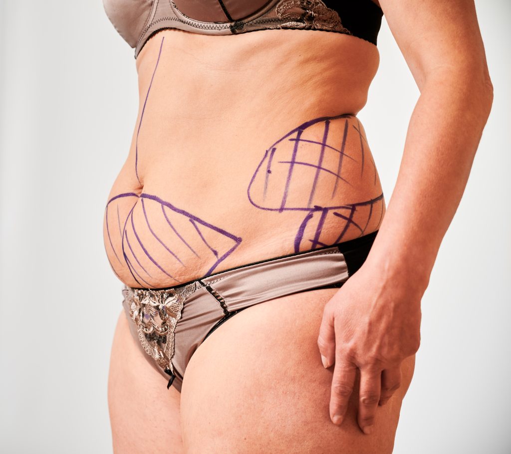 SculpSure Treatment
