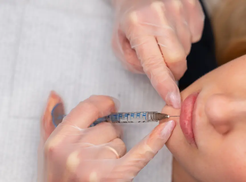 the-basics-of-injectable-fillers-by-jim-brantner-md Dermal Filler Injections By Jim Brantner, MD