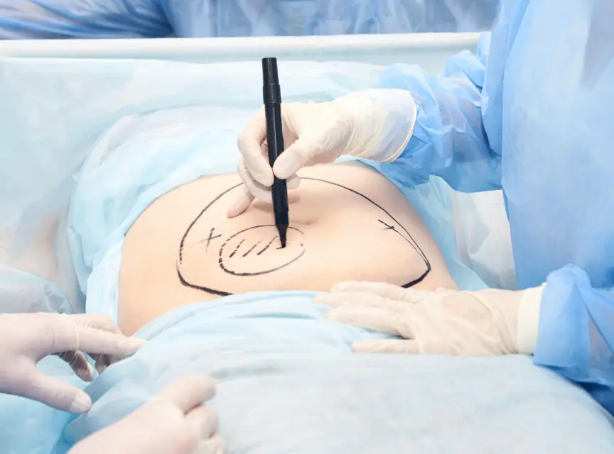 Full-Body Liposuction For Better Morale