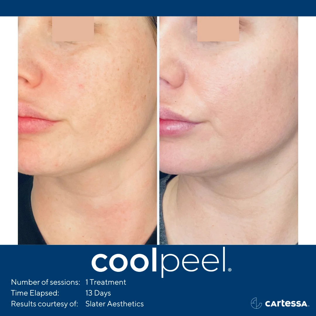 CO2 Cool Peel Treatment in TN