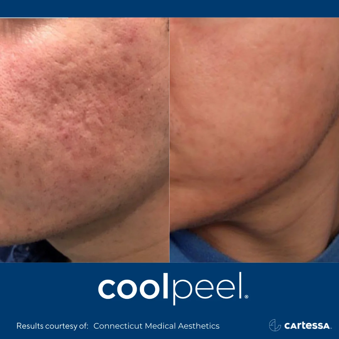 CoolPeelBACheek