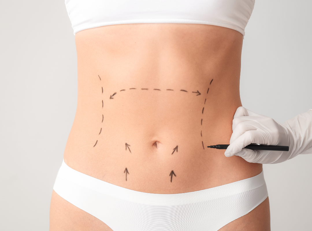 Do Tummy Tuck Scars Go Away