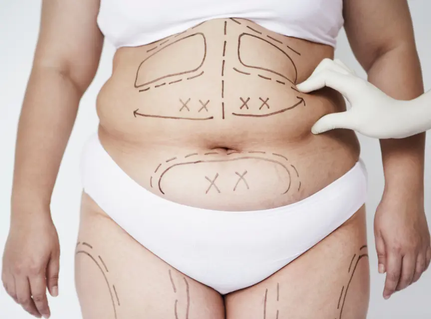 jim-brantner-md-mommy-makeover-options Mommy Makeover Surgery Safety & Risks