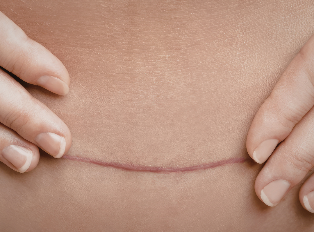 Is Abdominoplasty Permanent