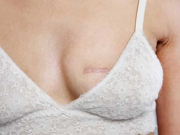 breast-reconstruction-procedure-jim-brantner-md Jim Brantner, MD BreastImplant and Breast Reconstruction