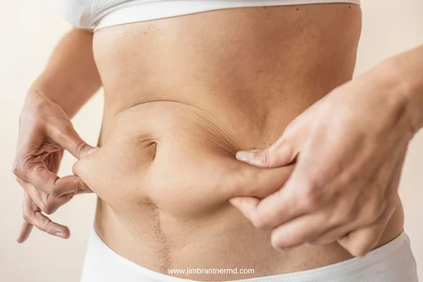 How Long Is the Recovery Period After a Tummy Tuck