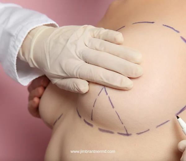 Should I Choose a Vertical or Anchor Incision Breast Lift
