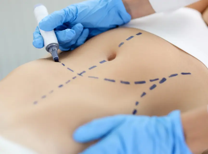 Difference Between a Tummy Tuck and an Extended Tummy Tuck