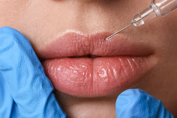 how-much-do-lip-fillers-usually-cost-in-unicoi How Much Does One ML Of Lip Fillers Usually Cost