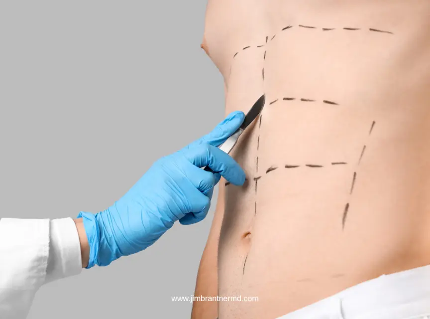Who Needs Extended Abdominoplasty Surgery