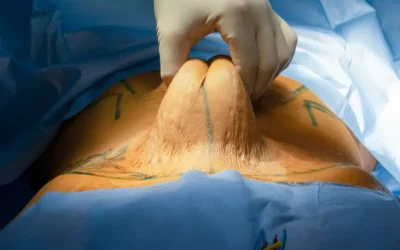 What Is Extended Abdominoplasty and Who Needs It