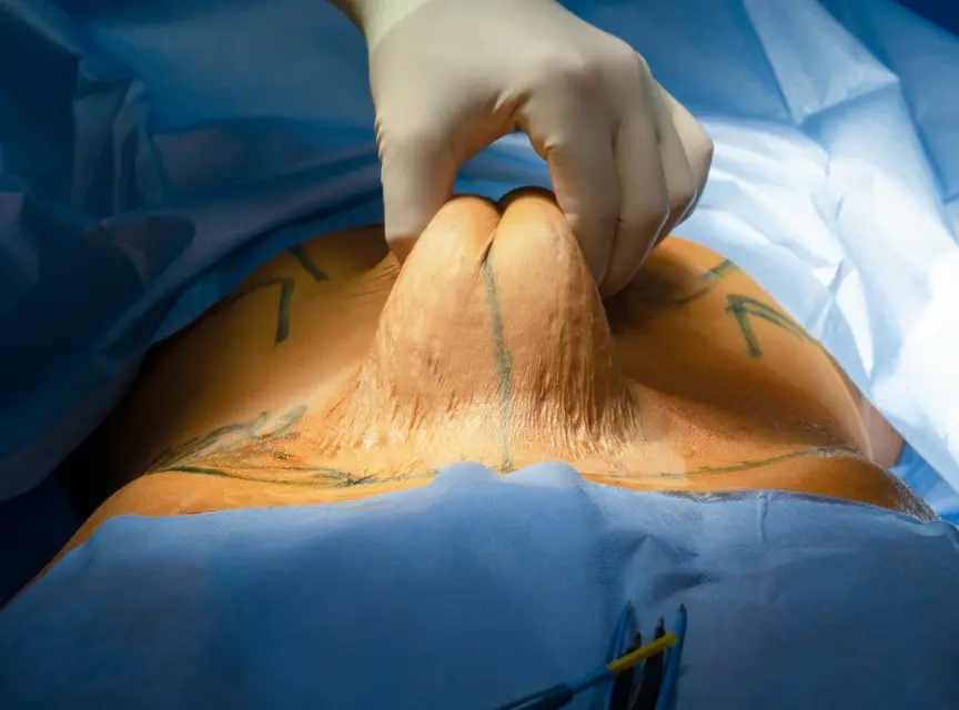 What Is Extended Abdominoplasty
