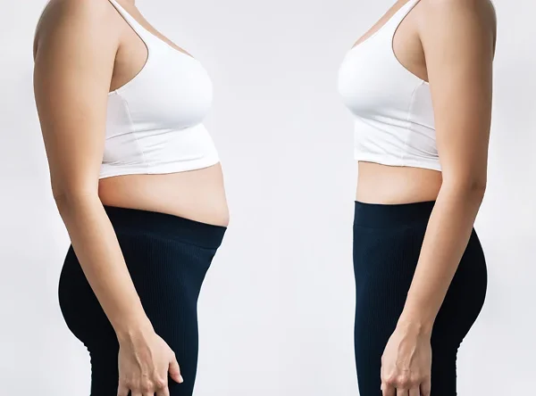 Does SculpSure® Really Work